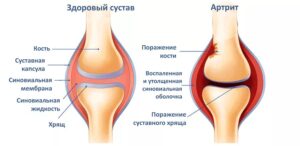 Артрит суставов