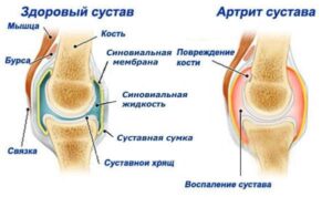 Артрит суставов