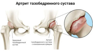 Артрит суставов